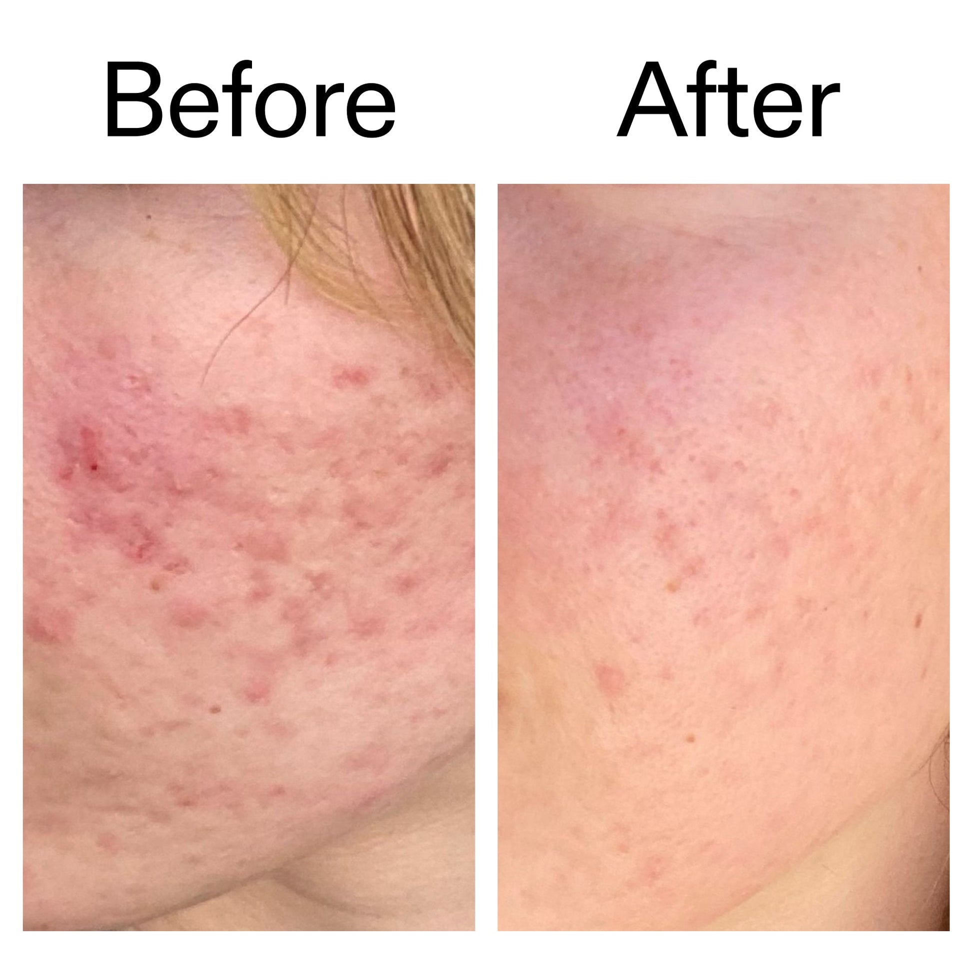 10-azelaic-acid-serum-for-redness-relief-l9 Azealic_Acid_Serum_B_A_Ppage_2000_x_2000.jpg