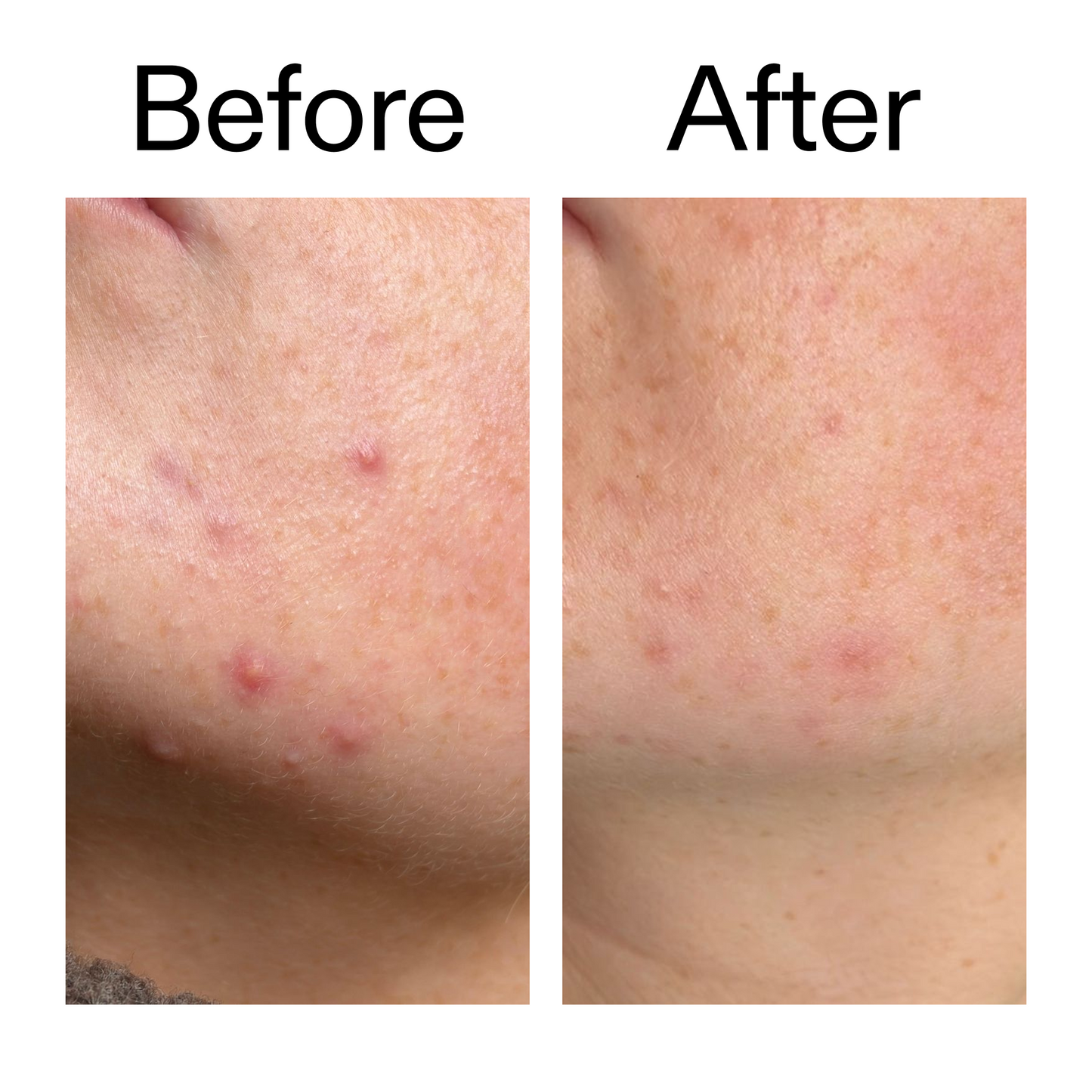 10-azelaic-acid-serum-for-redness-relief-l9 B_A_1_PPAGE.png
