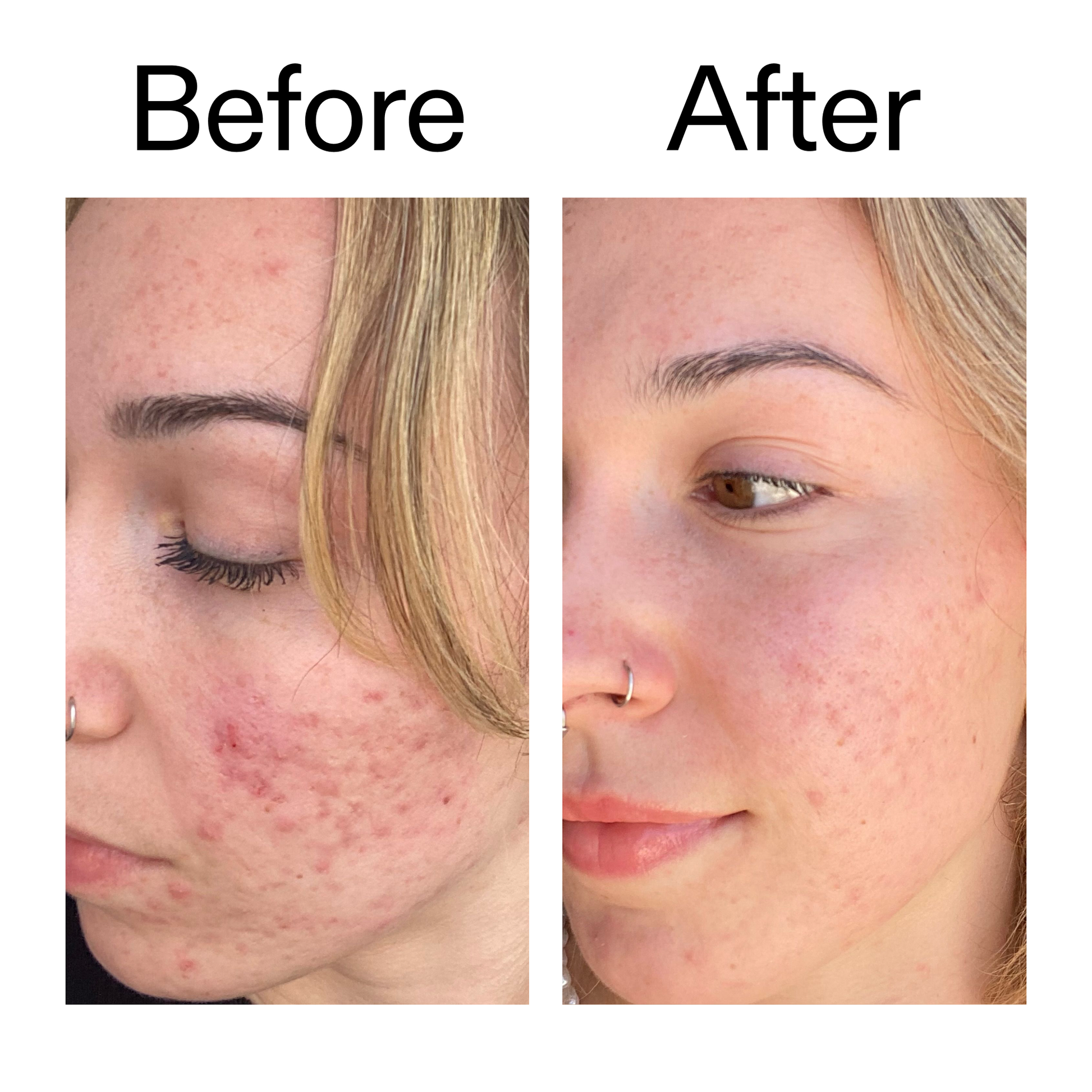 10-azelaic-acid-serum-for-redness-relief-v0 B_A_2_PPAGE.png
