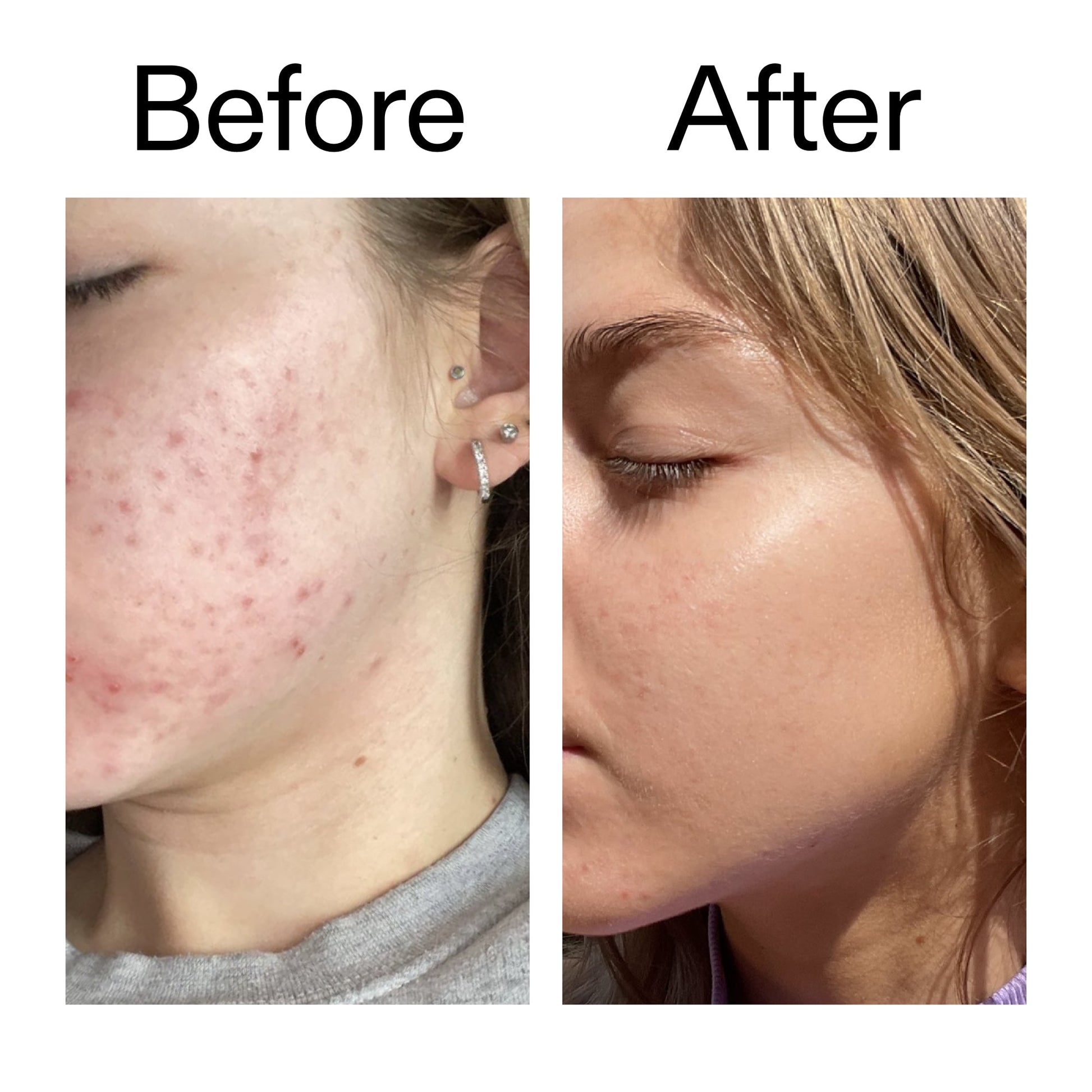 beta-hydroxy-acid-bha-serum-z0 Beta_Hydroxy_Acid_Serum_Before_After_2000x2000_96fda3e5-938d-49ef-bcf2-a0fa6ece4e2c.jpg