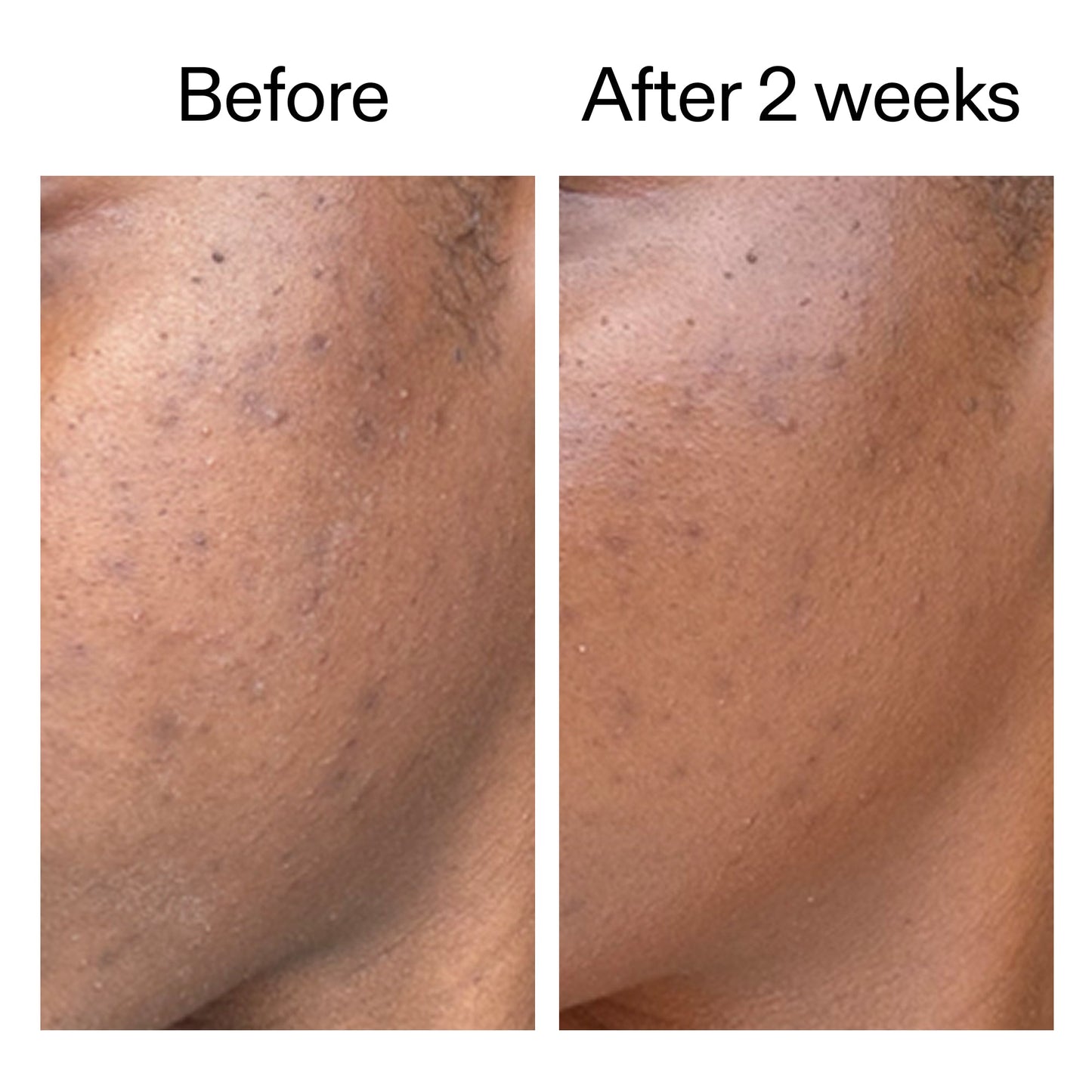 360-acne-clearing-serum-c0 DIOICB_A2000x2000.jpg