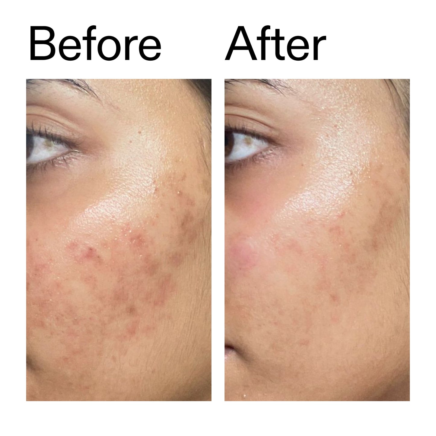 ectoin-hydro-barrier-serum-b2 Ectoin_Hydro-barrier_Serum__Before_After_2000x2000_34261920-d004-48d0-9c7b-8e1c15971bfd.jpg