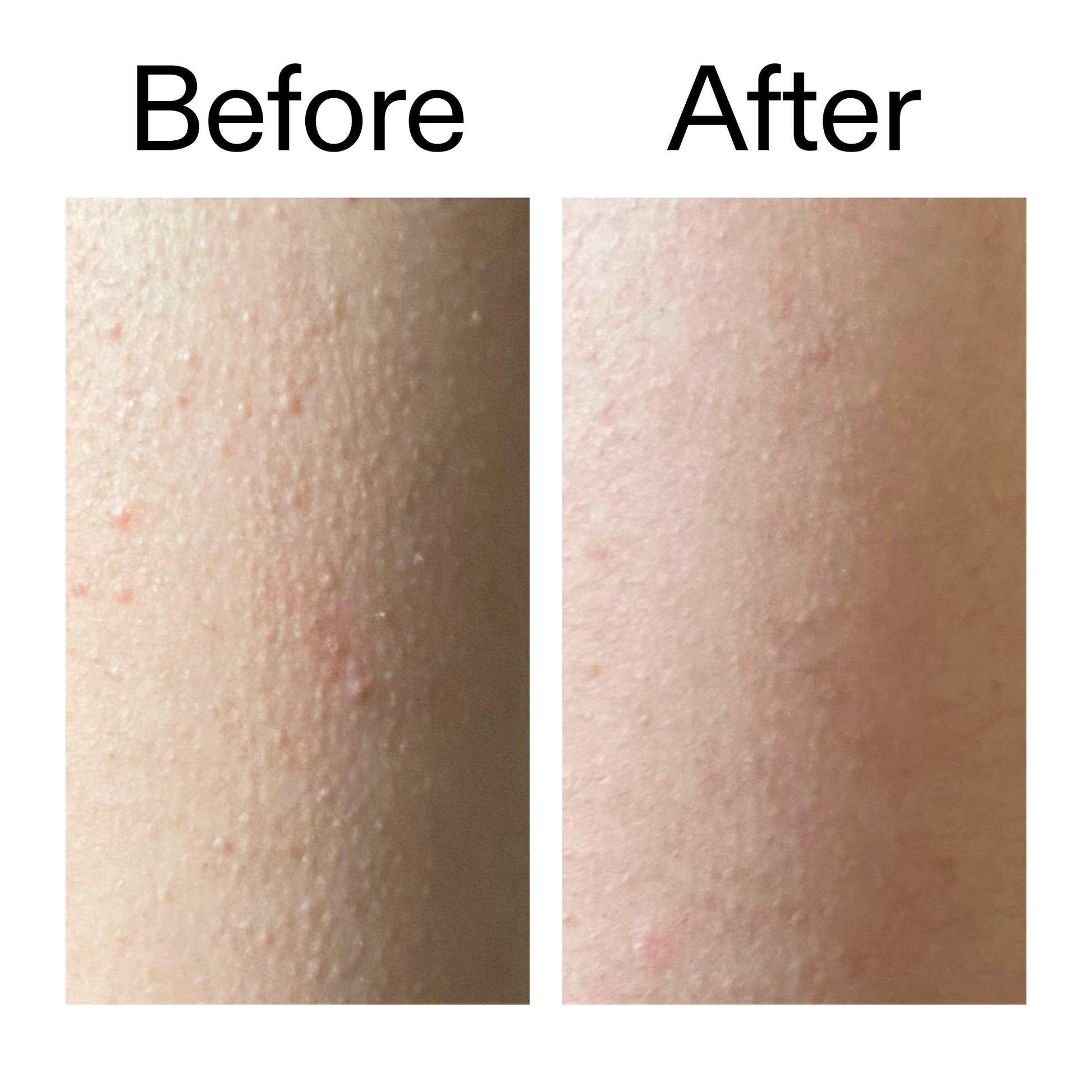 glycolic-acid-exfoliating-body-stick-duo-g6 Glycolic_Acid_Exfoliating_Body_Stick_Before_After_V2_2000x2000_2e4ba052-94f6-4d56-82df-7bdb5b2df7ae.jpg
