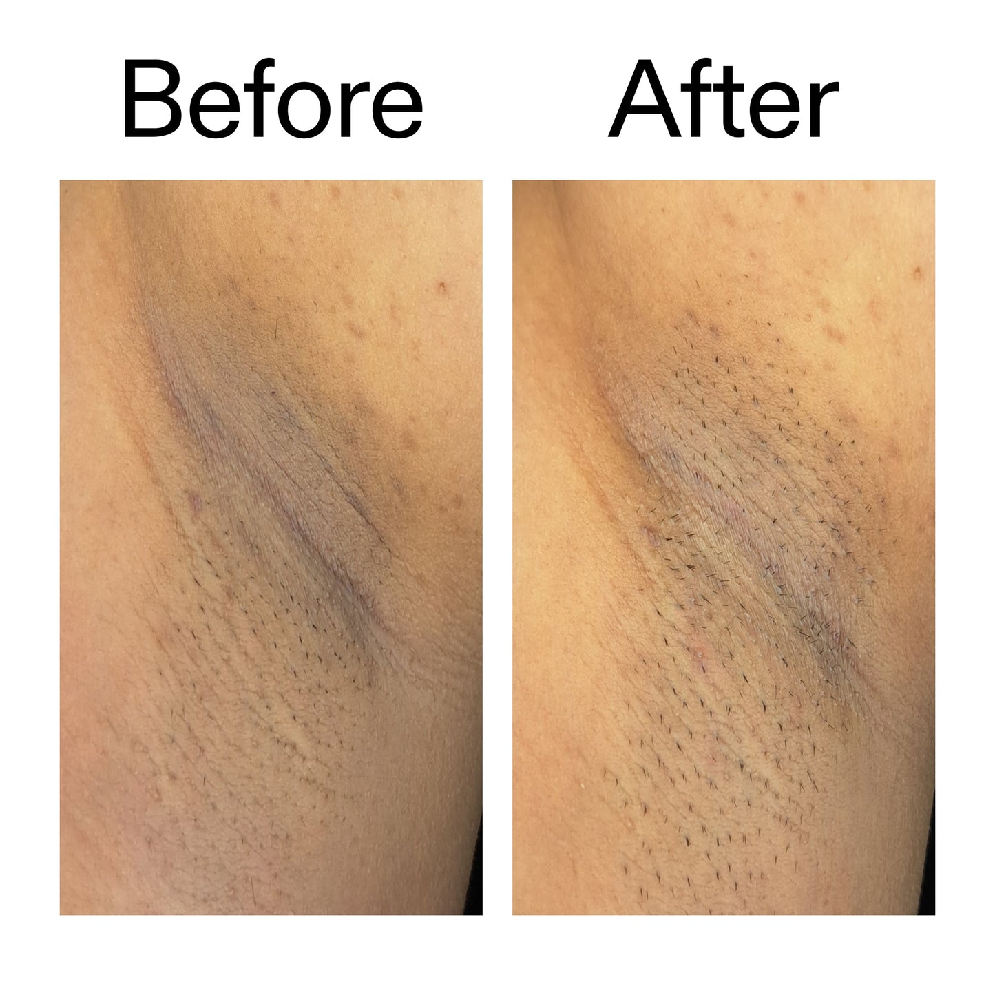 glycolic-acid-exfoliating-body-stick-z0 Glycolic_Acid_Exfoliating_Body_Stick_Before_After_V3_2000x2000_ea919cd9-1439-4a46-82a0-76200eb5bb42.jpg