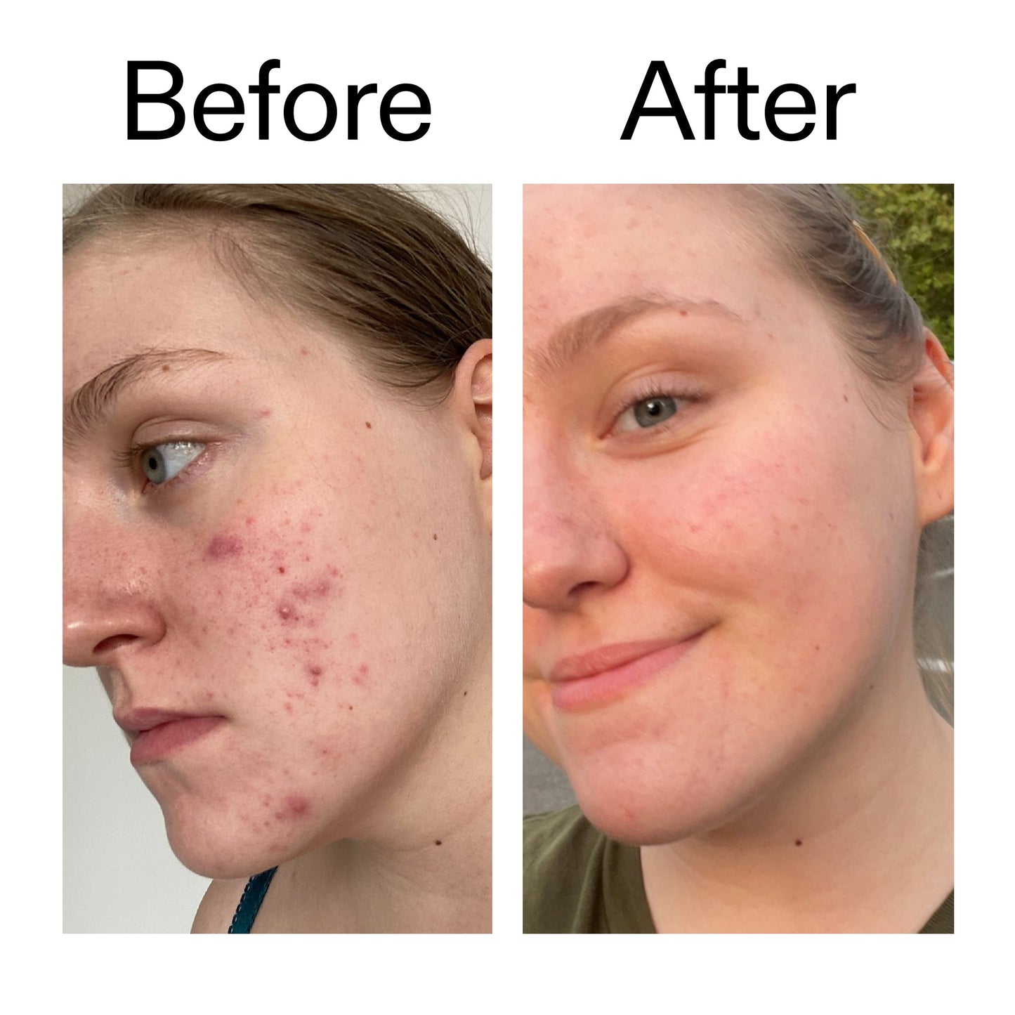 glycolic-acid-toner-h8 Glycolic_Acid_Toner_Before_After_2000x2000_49f0b9f7-e71b-4b2e-a8f8-2ea4b73247bb.jpg