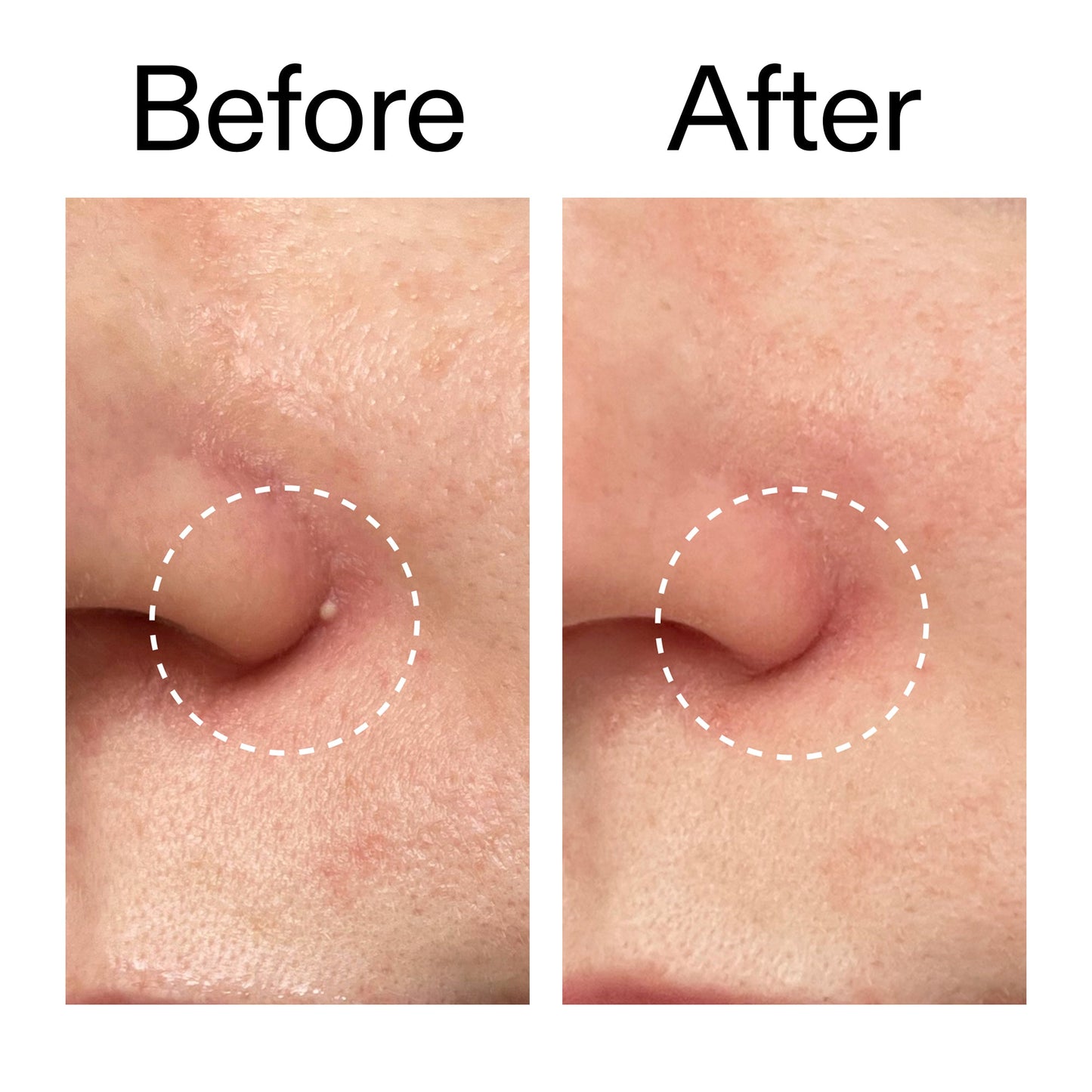 hydrocolloid-invisible-pimple-patches-pack-of-22-x9 Hydrocolloid_Invisible_Pimple_Patches_Before_After_2000x2000_b02aa37b-c78a-4682-91de-9135af5bb7df.jpg