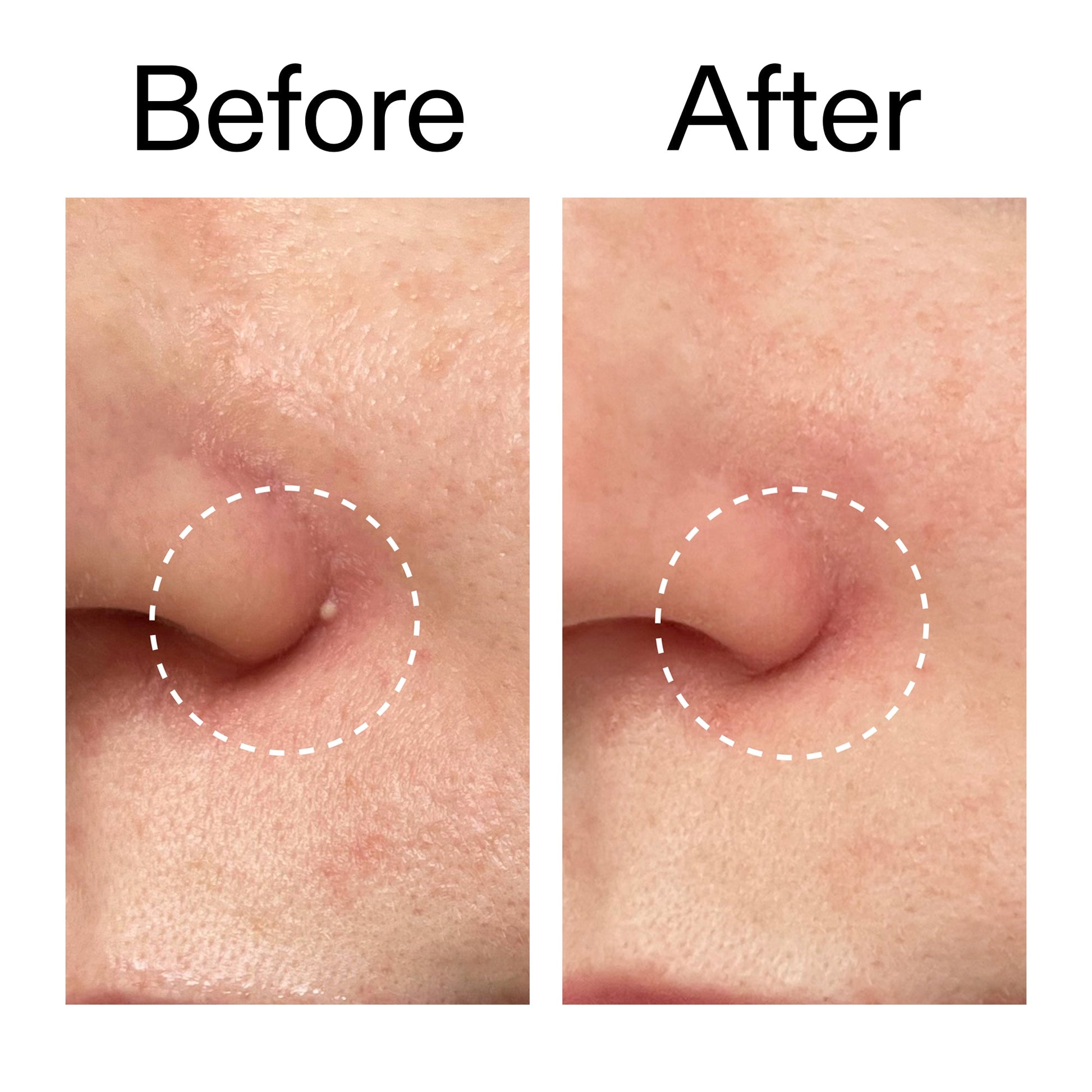 hydrocolloid-invisible-pimple-patches-pack-of-22-x9 Hydrocolloid_Invisible_Pimple_Patches_Before_After_2000x2000_b02aa37b-c78a-4682-91de-9135af5bb7df.jpg