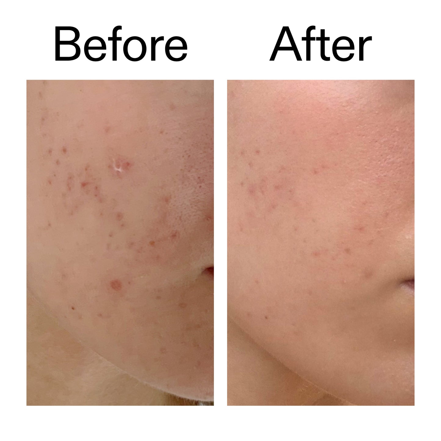 mandelic-acid-treatment-a7 Mandelic_Acid_Treatment_Before_After_2000x2000_4885ac6e-c5d7-4279-a72a-1417af7dce35.jpg