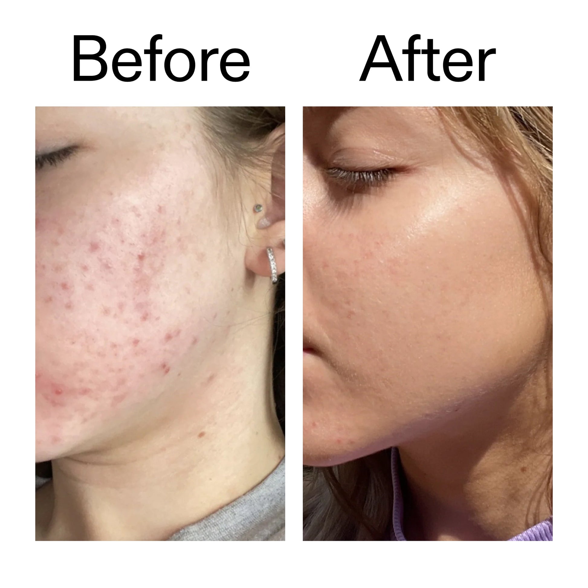 10-niacinamide-serum-duo-h3 Niacinamide_Serum_Before_After_2000x2000_bde32455-9e7d-448e-b053-bef41504f0a9.jpg