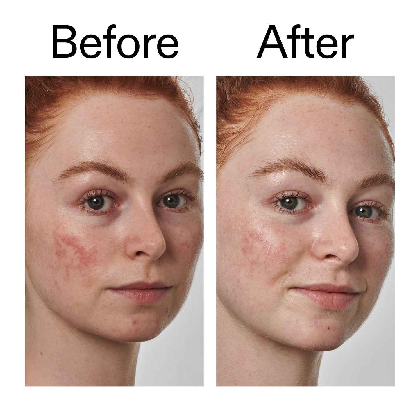 10-azelaic-acid-serum-for-redness-relief-v0 Redness_Relief_Serum_Before_After_2000x2000_3334dc9a-cce9-4e00-8aec-7ad89ca051f2.jpg
