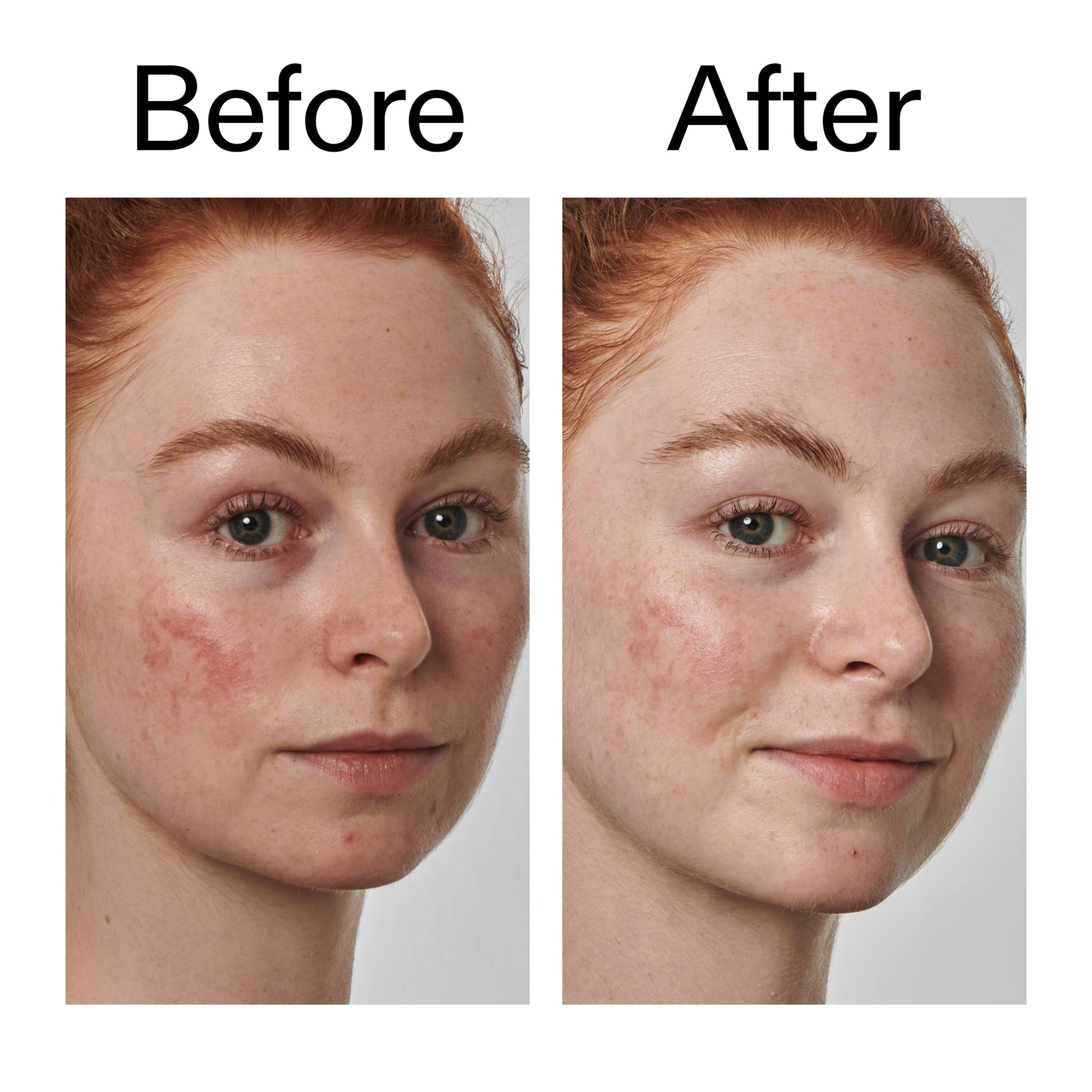 10-azelaic-acid-serum-for-redness-relief-l9 Redness_Relief_Serum_Before_After_2000x2000_3334dc9a-cce9-4e00-8aec-7ad89ca051f2.jpg