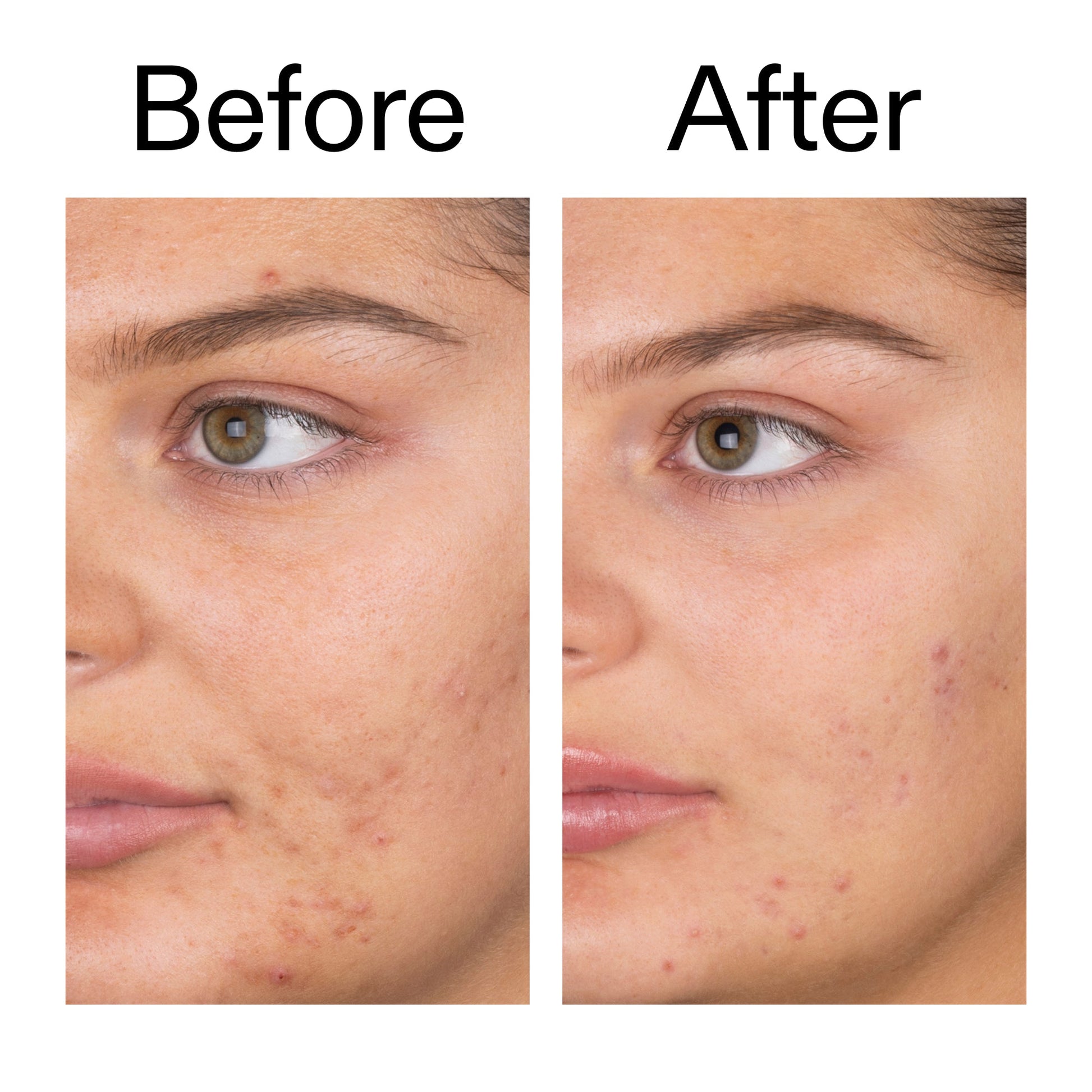 salicylic-acid-cleanser-duo-m5 Salicylic_Acid_Cleanser_-_150ml_Before_After_2000x2000_e7230494-853f-4b07-82b1-27669104c995.jpg