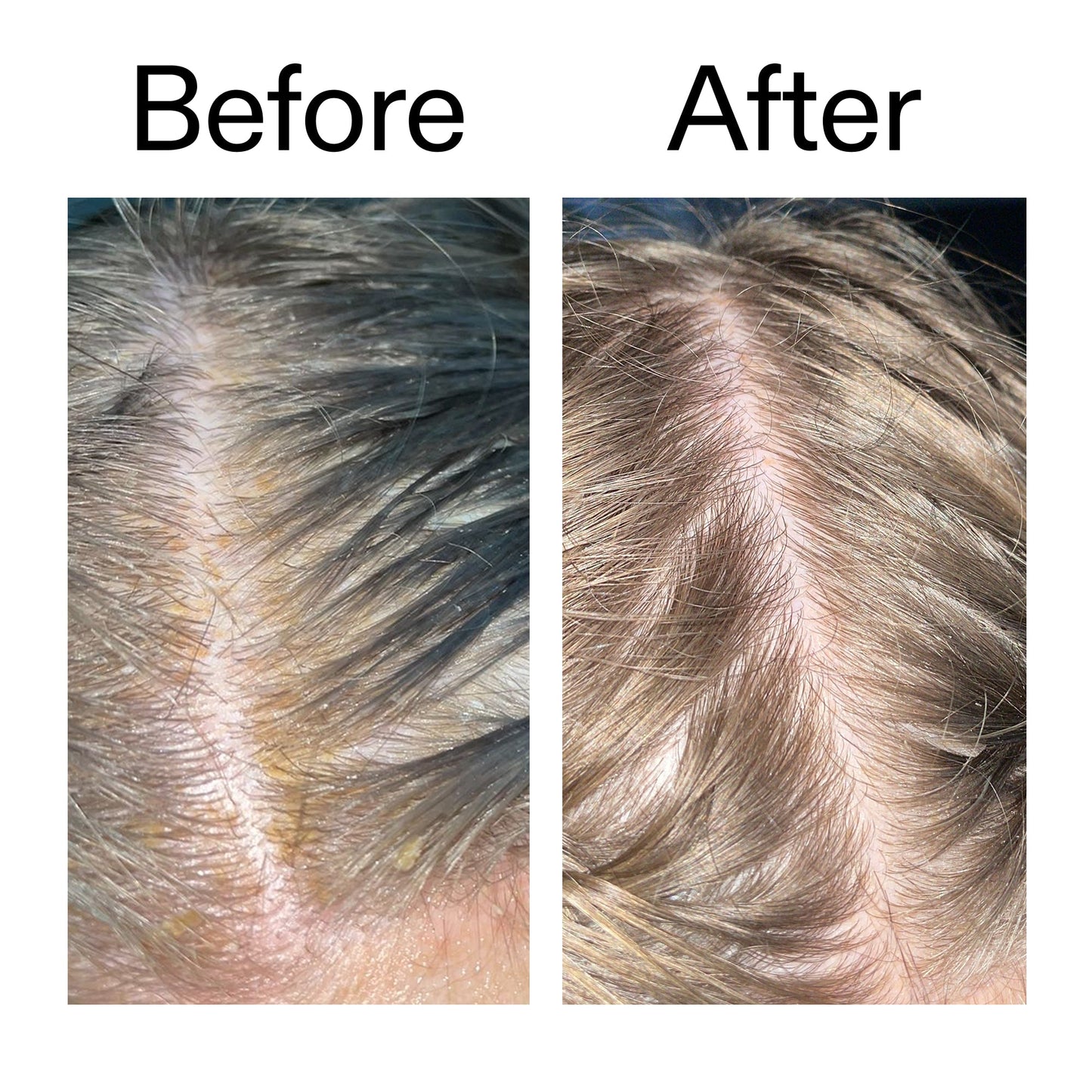 salicylic-acid-exfoliating-scalp-treatment-o6 Salicylic_Acid_Exfoliating_Scalp_Treatment_Before_After_2000x2000_e572a30f-057c-4a48-823b-1c09dc97f8d0.jpg