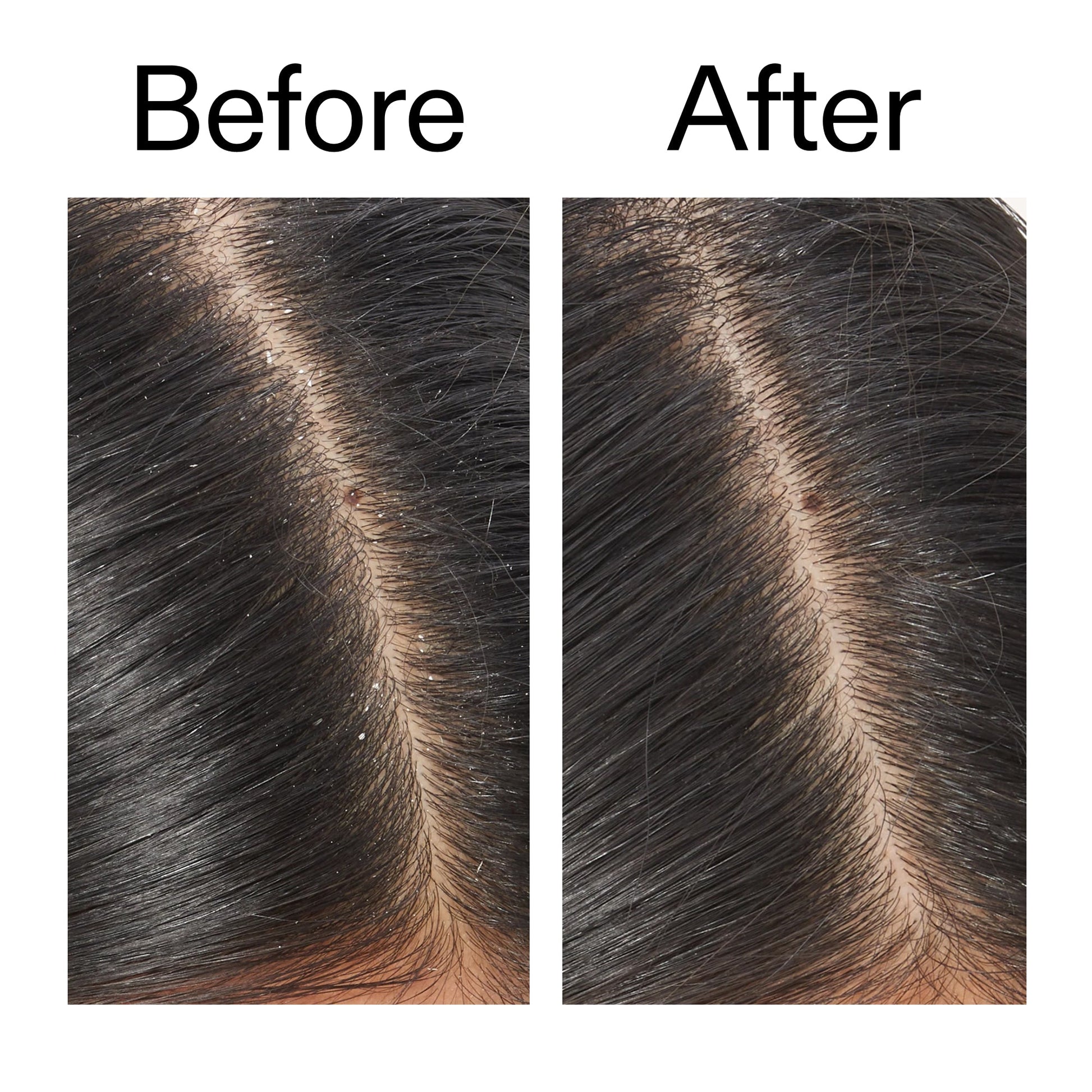 salicylic-acid-exfoliating-scalp-treatment-o6 Salicylic_Acid_Exfoliating_Scalp_Treatment_Before_After_V2_2000x2000_02bd61ad-42bf-490b-b3e3-7e04b2e8a673.jpg