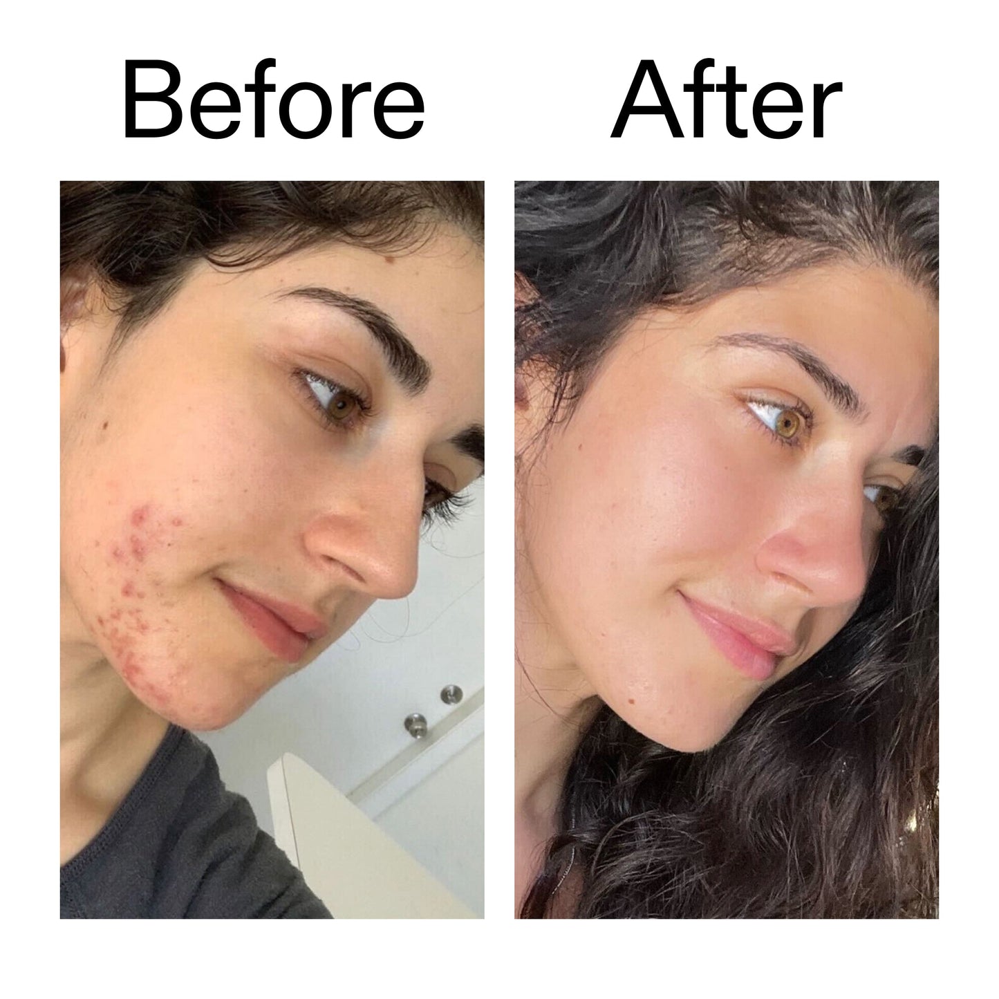 succinic-acid-acne-treatment-s3 Succinic_Acid_Treatment_Before_After_2000x2000_6a5f0054-2f58-4433-9314-0dc72c9bdd3b.jpg