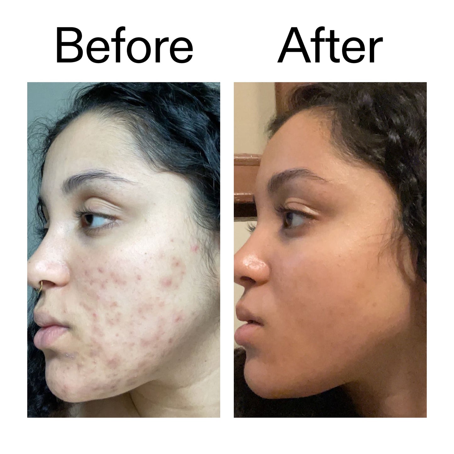 tranexamic-acid-serum-f4 Tranexamic_Acid_Serum_Before_After_2000x2000_98ebc8be-77b0-4843-8a22-90790ebe918b.jpg